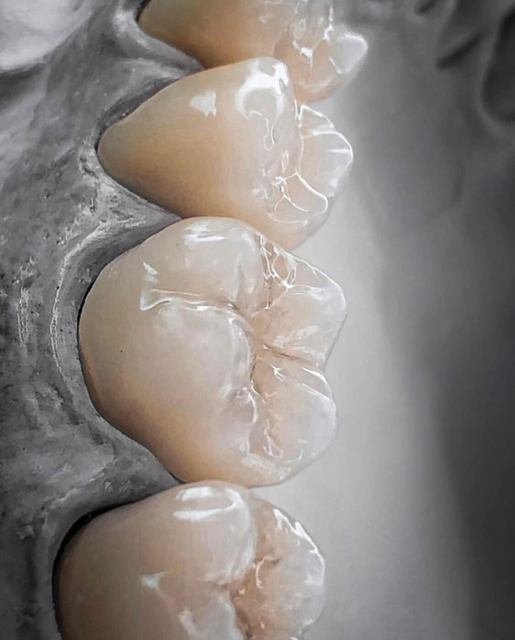 protesi dentali - Laboratorio odontotecnico Verzuolo