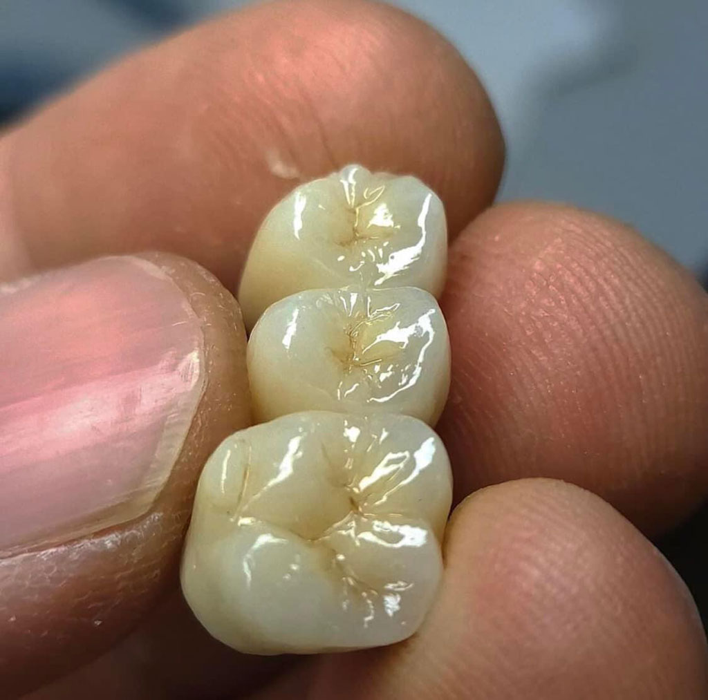 Laboratorio odontotecnico - protesi dentali parziali - Pelleri
