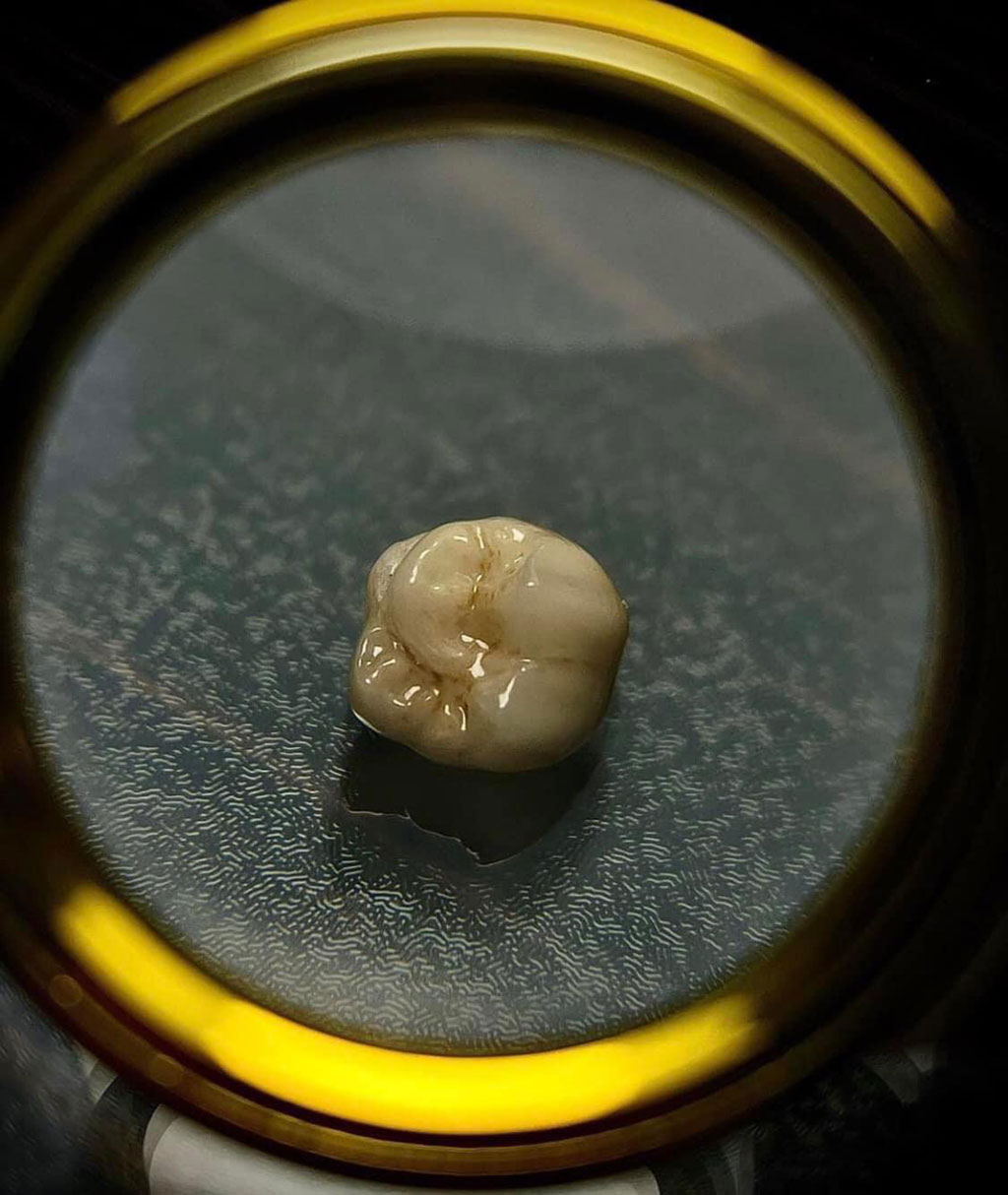 ricostruzioni dentali - Verzuolo Cuneo